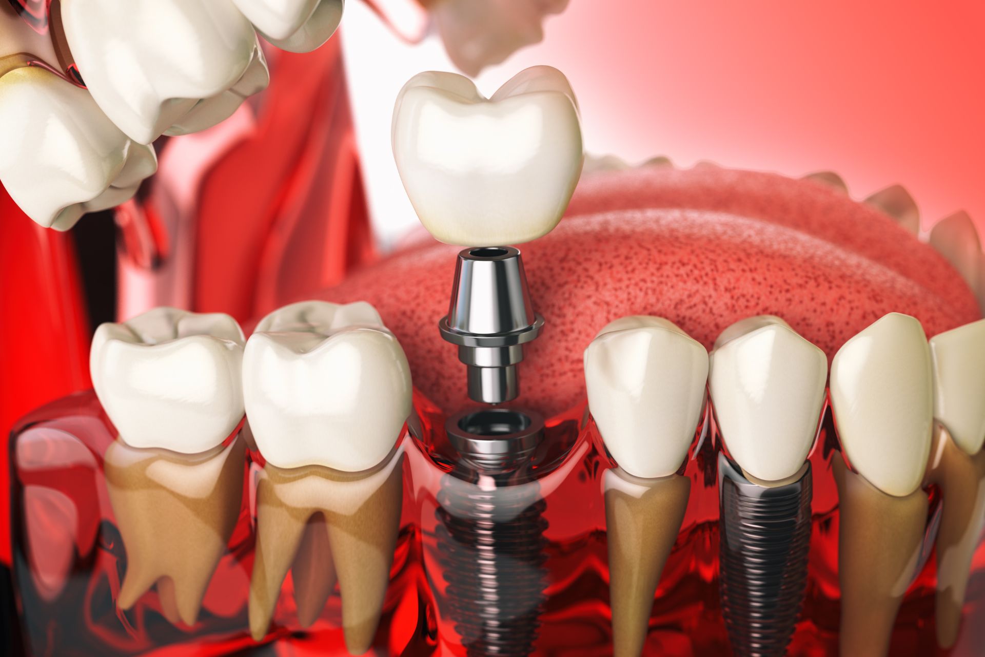 Was ist sinnvoller – eine Brücke oder ein Implantat?